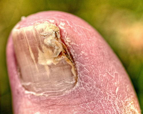 toenail-fungus-picture. Many people wonder if whatever treatment they use is