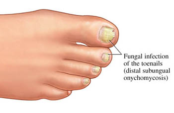 Diagram of Toenail Fungus