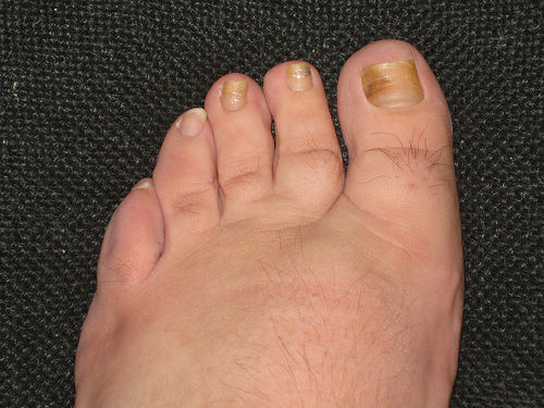 Often in nail infections several types of fungus will be present at the same