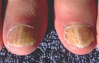 onychomycosis